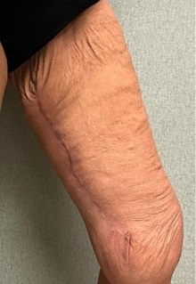 Thigh Lift After Photo by Michael Yang, MD; Bettendorf, IA - Case 50598