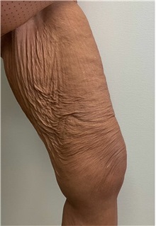 Thigh Lift Before Photo by Michael Yang, MD; Bettendorf, IA - Case 50598