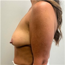Breast Lift Before Photo by Michael Yang, MD; Bettendorf, IA - Case 50595