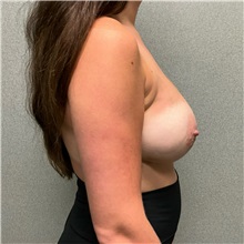 Breast Augmentation After Photo by Michael Yang, MD; Bettendorf, IA - Case 50601