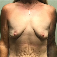 Breast Augmentation Before Photo by Michael Yang, MD; Bettendorf, IA - Case 50600