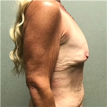 Breast Augmentation Before Photo by Michael Yang, MD; Bettendorf, IA - Case 50600