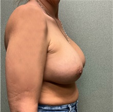 Breast Augmentation After Photo by Michael Yang, MD; Bettendorf, IA - Case 50602