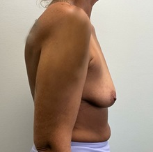 Breast Augmentation Before Photo by Michael Yang, MD; Bettendorf, IA - Case 50602