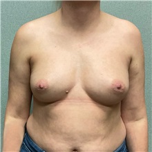 Breast Augmentation Before Photo by Michael Yang, MD; Bettendorf, IA - Case 50657