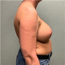 Breast Augmentation After Photo by Michael Yang, MD; Bettendorf, IA - Case 50657