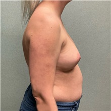 Breast Augmentation Before Photo by Michael Yang, MD; Bettendorf, IA - Case 50657