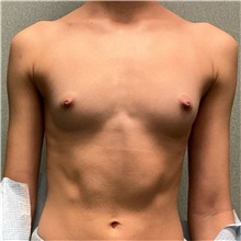 Breast Augmentation Before Photo by Michael Yang, MD; Bettendorf, IA - Case 50660