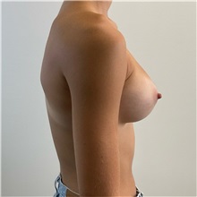Breast Augmentation After Photo by Michael Yang, MD; Bettendorf, IA - Case 50660