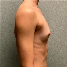 Breast Augmentation Before Photo by Michael Yang, MD; Bettendorf, IA - Case 50660