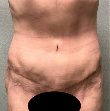 Tummy Tuck After Photo by Michael Yang, MD; Bettendorf, IA - Case 50659
