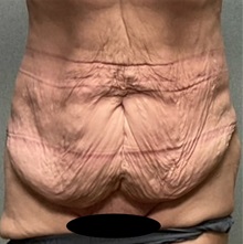 Tummy Tuck Before Photo by Michael Yang, MD; Bettendorf, IA - Case 50659