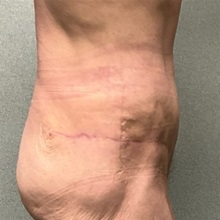 Tummy Tuck After Photo by Michael Yang, MD; Bettendorf, IA - Case 50659