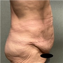 Tummy Tuck Before Photo by Michael Yang, MD; Bettendorf, IA - Case 50659