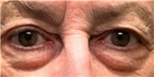 Eyelid Surgery Before Photo by Michael Yang, MD; Bettendorf, IA - Case 50656