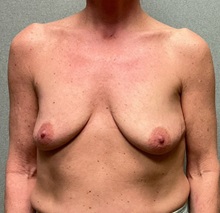 Breast Augmentation Before Photo by Michael Yang, MD; Bettendorf, IA - Case 50658