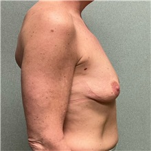 Breast Augmentation Before Photo by Michael Yang, MD; Bettendorf, IA - Case 50658