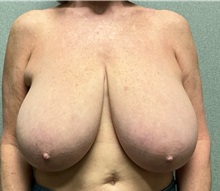 Breast Reduction Before Photo by Michael Yang, MD; Bettendorf, IA - Case 50661