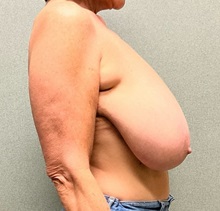 Breast Reduction Before Photo by Michael Yang, MD; Bettendorf, IA - Case 50661