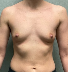 Breast Augmentation Before Photo by Michael Yang, MD; Bettendorf, IA - Case 50662