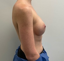 Breast Augmentation After Photo by Michael Yang, MD; Bettendorf, IA - Case 50662
