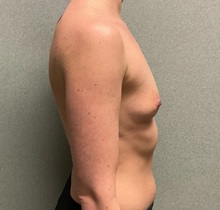 Breast Augmentation Before Photo by Michael Yang, MD; Bettendorf, IA - Case 50662