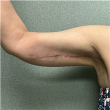 Arm Lift After Photo by Michael Yang, MD; Bettendorf, IA - Case 50668