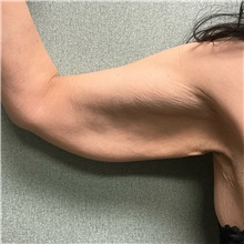 Arm Lift Before Photo by Michael Yang, MD; Bettendorf, IA - Case 50668