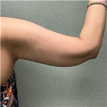 Arm Lift After Photo by Michael Yang, MD; Bettendorf, IA - Case 50668
