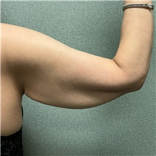 Arm Lift Before Photo by Michael Yang, MD; Bettendorf, IA - Case 50668