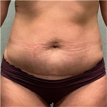 Tummy Tuck After Photo by Michael Yang, MD; Bettendorf, IA - Case 50666