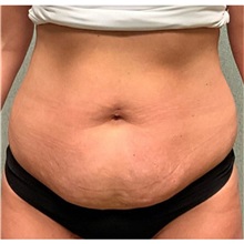 Tummy Tuck Before Photo by Michael Yang, MD; Bettendorf, IA - Case 50666