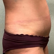 Tummy Tuck After Photo by Michael Yang, MD; Bettendorf, IA - Case 50666