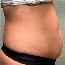 Tummy Tuck Before Photo by Michael Yang, MD; Bettendorf, IA - Case 50666