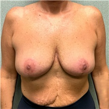 Breast Lift After Photo by Michael Yang, MD; Bettendorf, IA - Case 50670