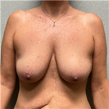 Breast Lift Before Photo by Michael Yang, MD; Bettendorf, IA - Case 50670