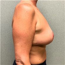 Breast Lift After Photo by Michael Yang, MD; Bettendorf, IA - Case 50670