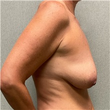 Breast Lift Before Photo by Michael Yang, MD; Bettendorf, IA - Case 50670