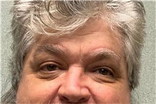 Eyelid Surgery After Photo by Michael Yang, MD; Bettendorf, IA - Case 50667