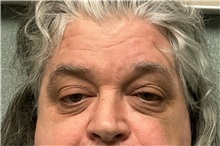 Eyelid Surgery Before Photo by Michael Yang, MD; Bettendorf, IA - Case 50667