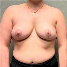 Breast Reduction After Photo by Michael Yang, MD; Bettendorf, IA - Case 50669