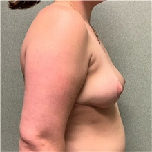 Breast Reduction After Photo by Michael Yang, MD; Bettendorf, IA - Case 50669