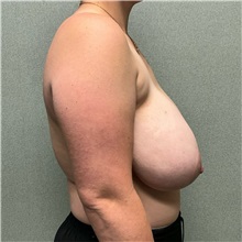 Breast Reduction Before Photo by Michael Yang, MD; Bettendorf, IA - Case 50669