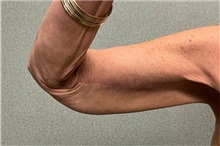 Arm Lift After Photo by Michael Yang, MD; Bettendorf, IA - Case 50672