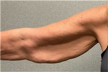 Arm Lift Before Photo by Michael Yang, MD; Bettendorf, IA - Case 50672