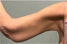 Arm Lift After Photo by Michael Yang, MD; Bettendorf, IA - Case 50672