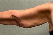 Arm Lift Before Photo by Michael Yang, MD; Bettendorf, IA - Case 50672