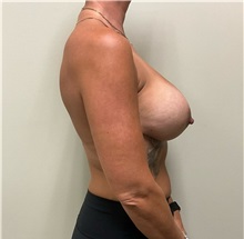 Breast Implant Revision After Photo by Michael Yang, MD; Bettendorf, IA - Case 50682