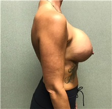 Breast Implant Revision Before Photo by Michael Yang, MD; Bettendorf, IA - Case 50682