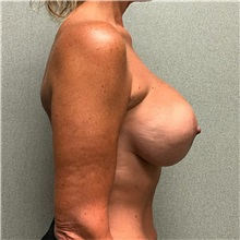 Breast Implant Revision After Photo by Michael Yang, MD; Bettendorf, IA - Case 50680
